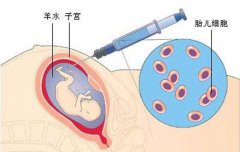 做羊水穿刺的目的是什么 羊水穿刺手术前后注意